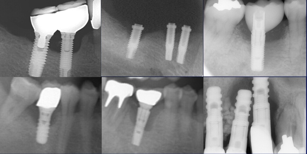 インプラント周囲炎のレントゲン